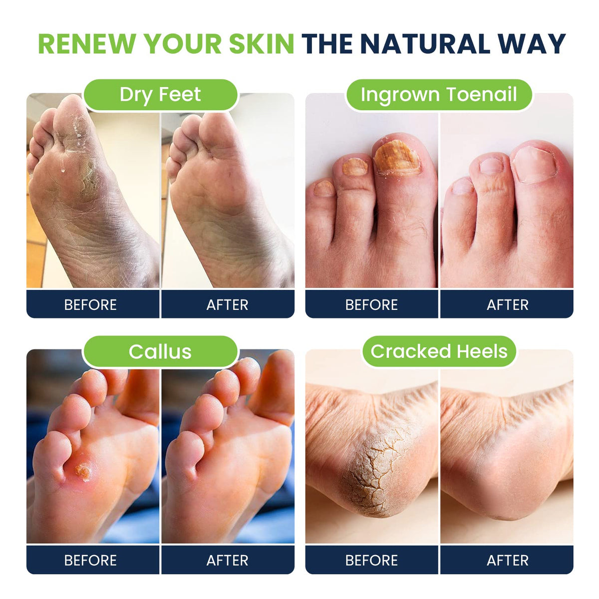 Foot Soak with Epsom Salts- Variety Pack of 4- Tea Tree Oil, Muscle Relief, Calming