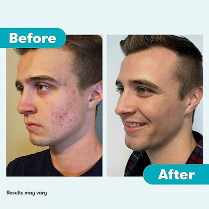 Proactiv 3 Step Acne Treatment - Benzoyl Peroxide Face Wash, Repairing Acne Spot