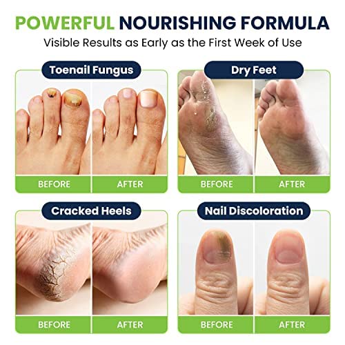Toenail Fungus Treatment Extra Strength - Advance nail fungus treatment for fingernails