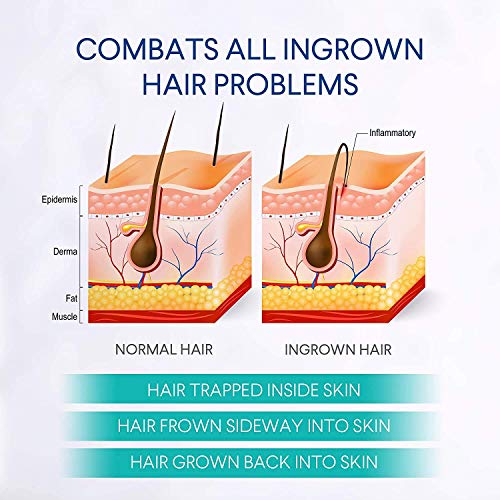 Razor Bumps Treatment for Women and Men, Ingrown Hair Treatment, Razor Bump Treatment