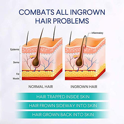 Razor Bumps Treatment for Women and Men, Ingrown Hair Treatment, Razor Bump Treatment