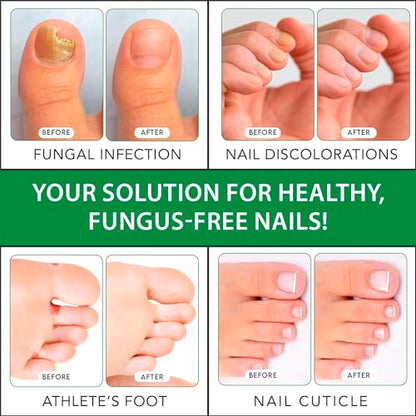 Viking Revolution Toenail Fungus Treatment Extra Strength with 1% Tolnaftate OTC