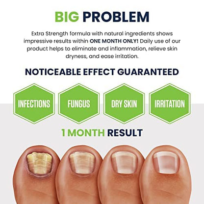 Toenail Fungus Treatment Extra Strength - Advance nail fungus treatment for fingernails