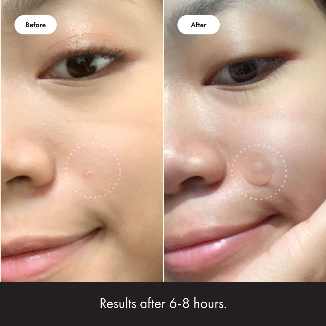 Mighty Patch Original from Hero Cosmetics - Hydrocolloid Acne Pimple