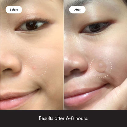 Mighty Patch Original from Hero Cosmetics - Hydrocolloid Acne Pimple