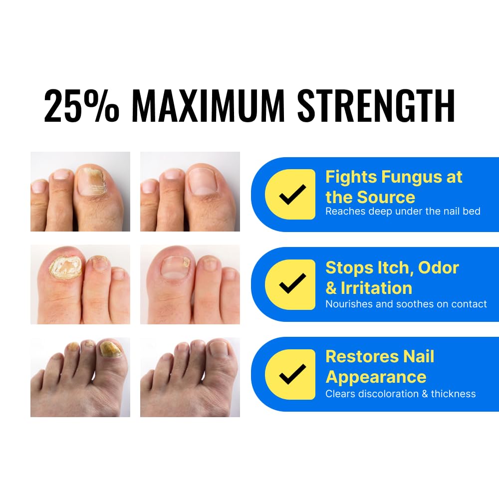 Approved Science Fungix Extra Strength - Undecylenic Acid and Tea Tree Oil - Serum for Fingernail and Toenail Care - Infused with Essential Oils - Healthy Nail Appearance - Easy to Apply - Pack of 1