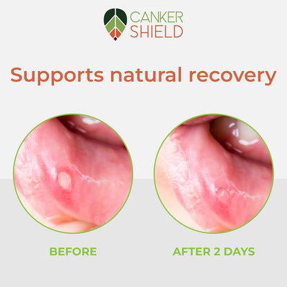 – Natural Canker Sore & Mouth Ulcer Relief Powder – Soothing Oral Powder for Targeted Mouth Comfort