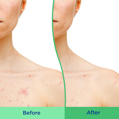 Differin Body Scrub with Salicylic Acid Acne Clearing Improves Tone and Texture Prone Skin