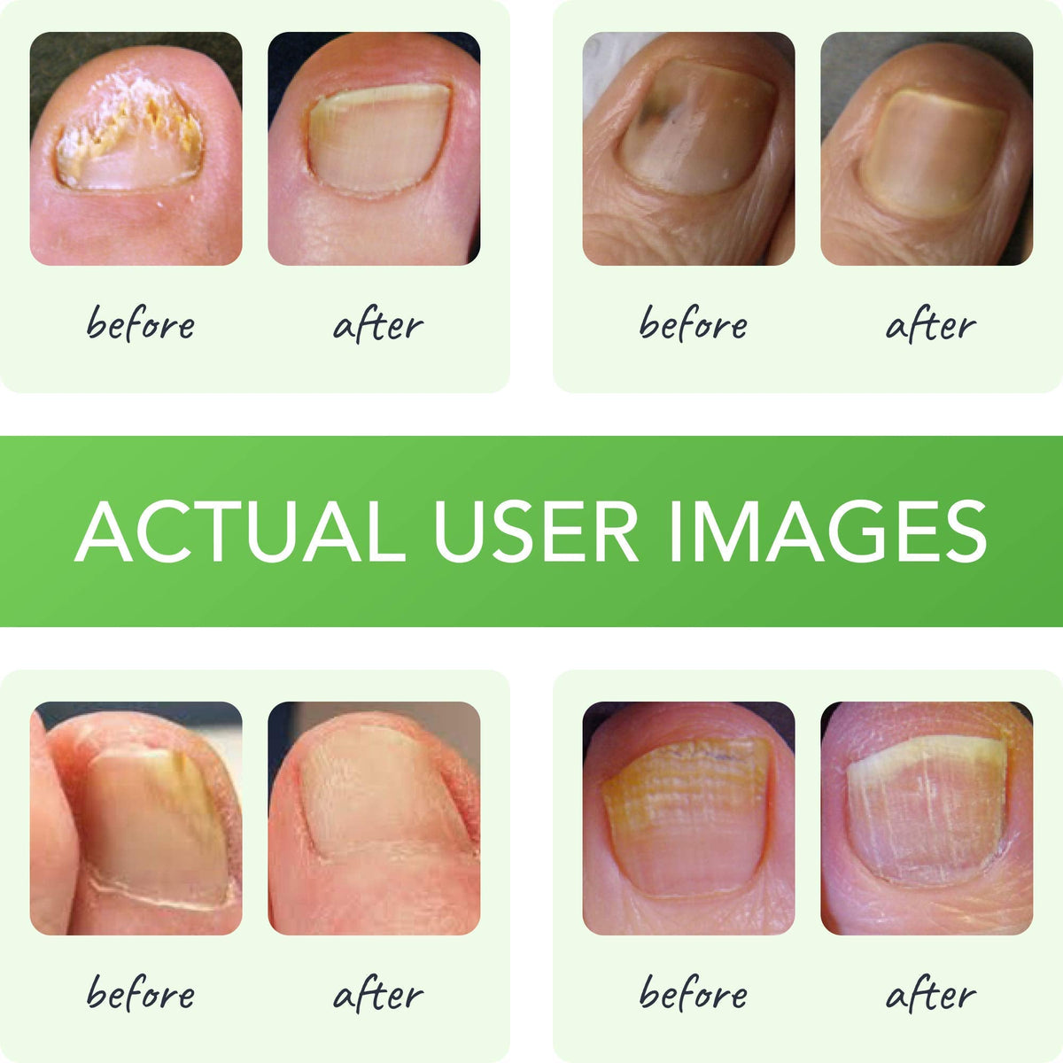 FUNGINIX Healthy Nail Formula - Finger And Toe Fungus Treatment, Made In USA, Foot