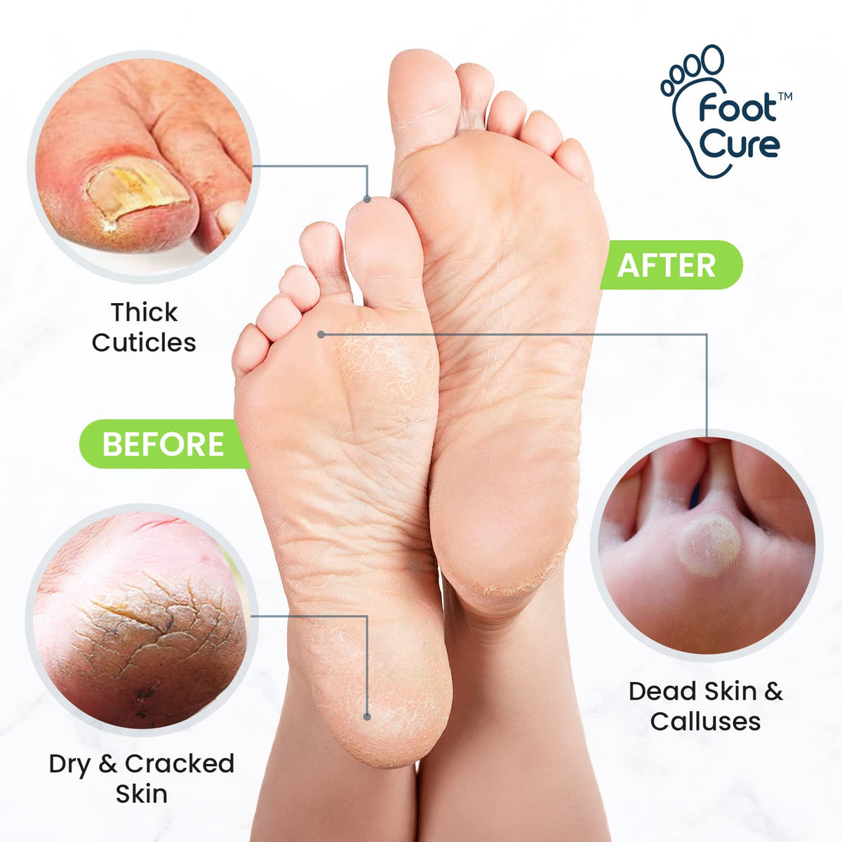 Toenail Fungus Treatment Extra Strength - Advance nail fungus treatment for fingernails