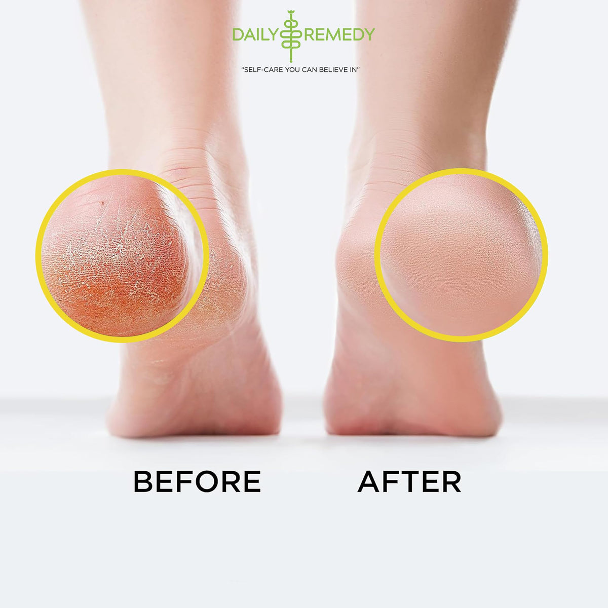 Citrus Detox Foot Soak with Epsom Salt - for Foot Callus, Immune Boost, Damaged Toenail