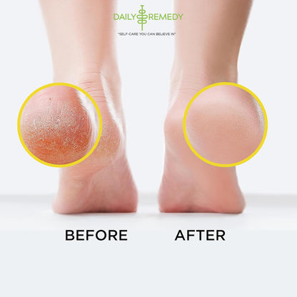 Citrus Detox Foot Soak with Epsom Salt - for Foot Callus, Immune Boost, Damaged Toenail
