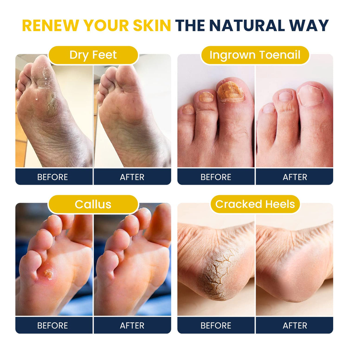 Citrus Detox Foot Soak With Epsom Salts - for Foot Callus, Immune Boost, Damaged Toenail