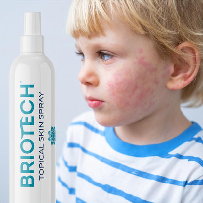 BRIOTECH Hypochlorous Acid Spray, Topical Skin Face & Body Mist, Support Irritations
