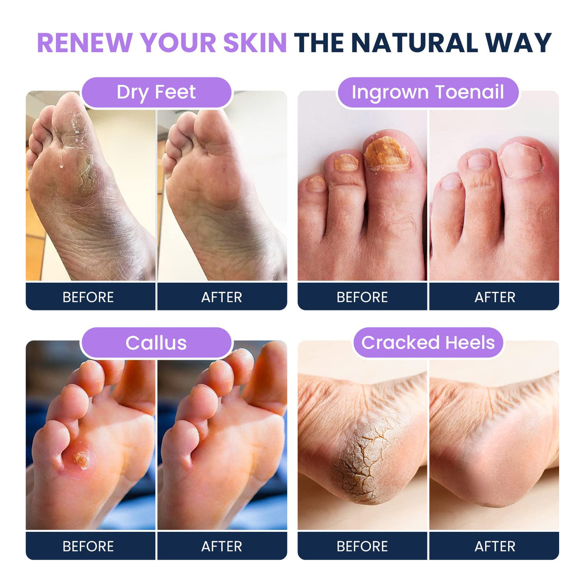 Soothing Lavender Foot Soak with Epsom Salt - Best Toenail Treatment, & Softens Calluses