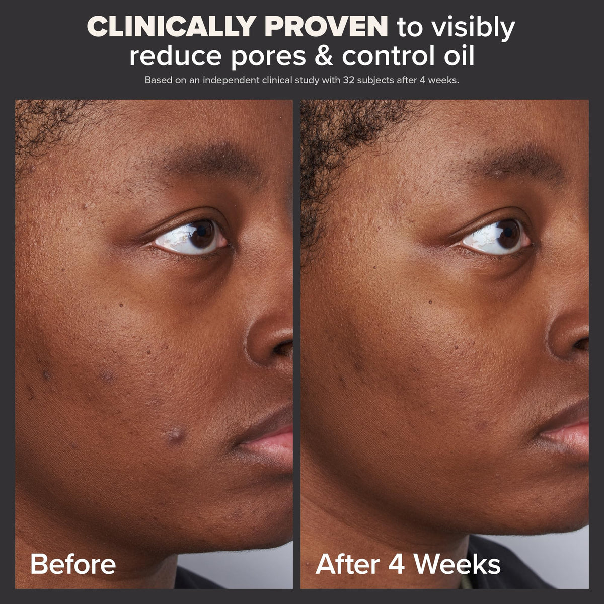 Paula's Choice Skin Perfecting 2% BHA Liquid Salicylic Acid Exfoliant, Gentle Facial Exfoliator