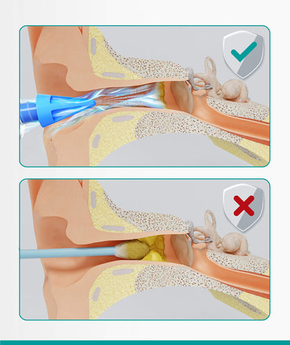 Medi Grade Ear Syringe Ear Wax Removal Kit with 3 Quad-stream Tips