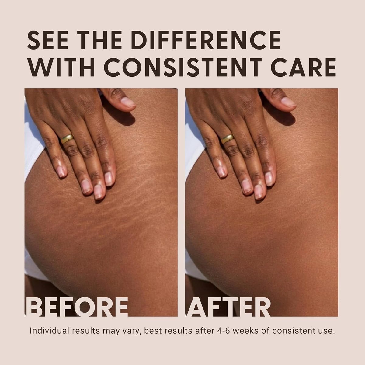M3 Stretch Mark Cream for Pregnancy, with Collagen and Stem Cell, 4 oz
