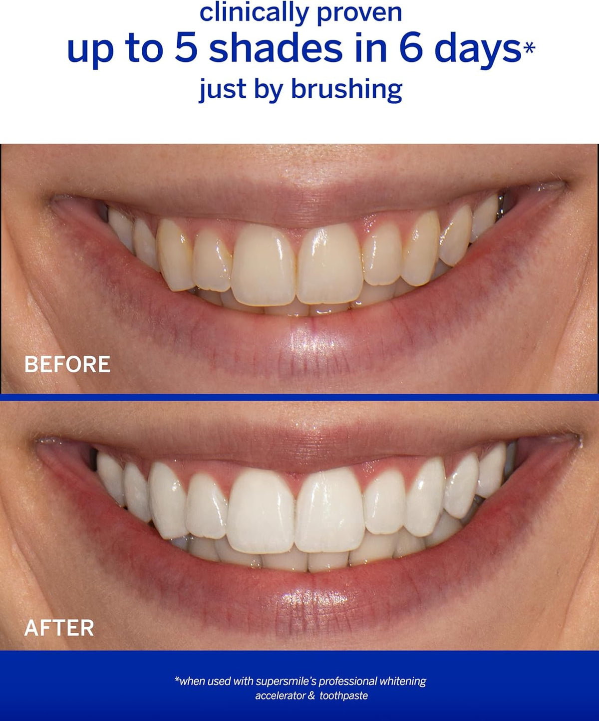 Supersmile Wild Mint Whitening System, 8 Oz Toothpaste + Accelerator