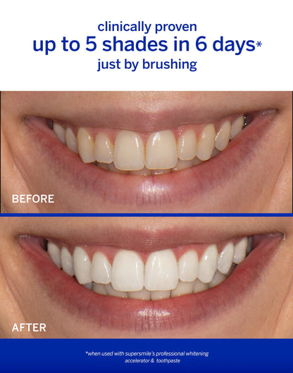 Supersmile Wild Mint Whitening System, 8 Oz Toothpaste + Accelerator
