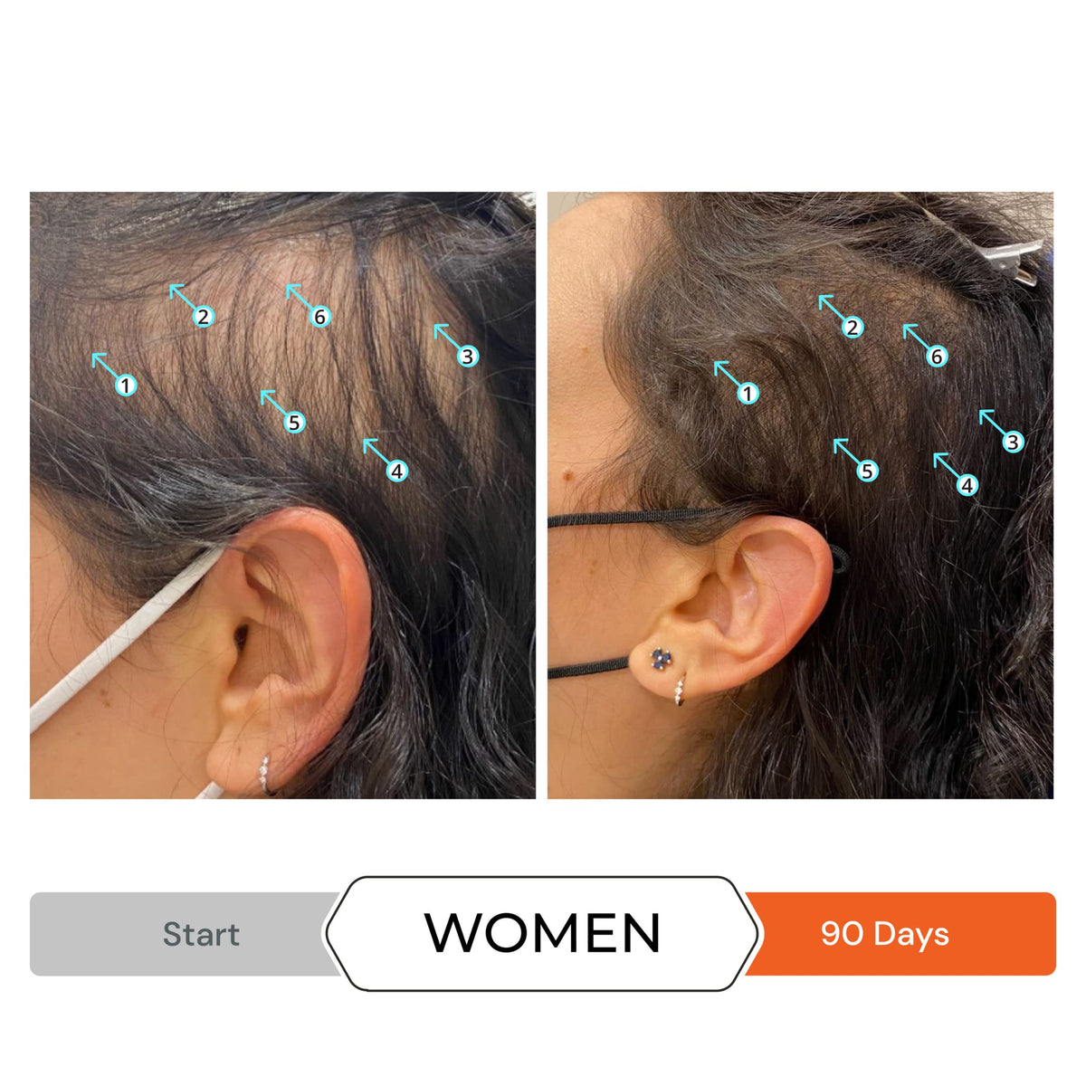 Revita Shampoo and Spectral.DNC-N Serum for Hair Thinning by DS Laboratories